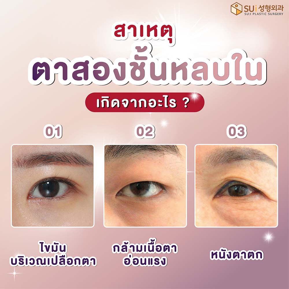 ตาสองชั้นหลบใน เกิดจาก