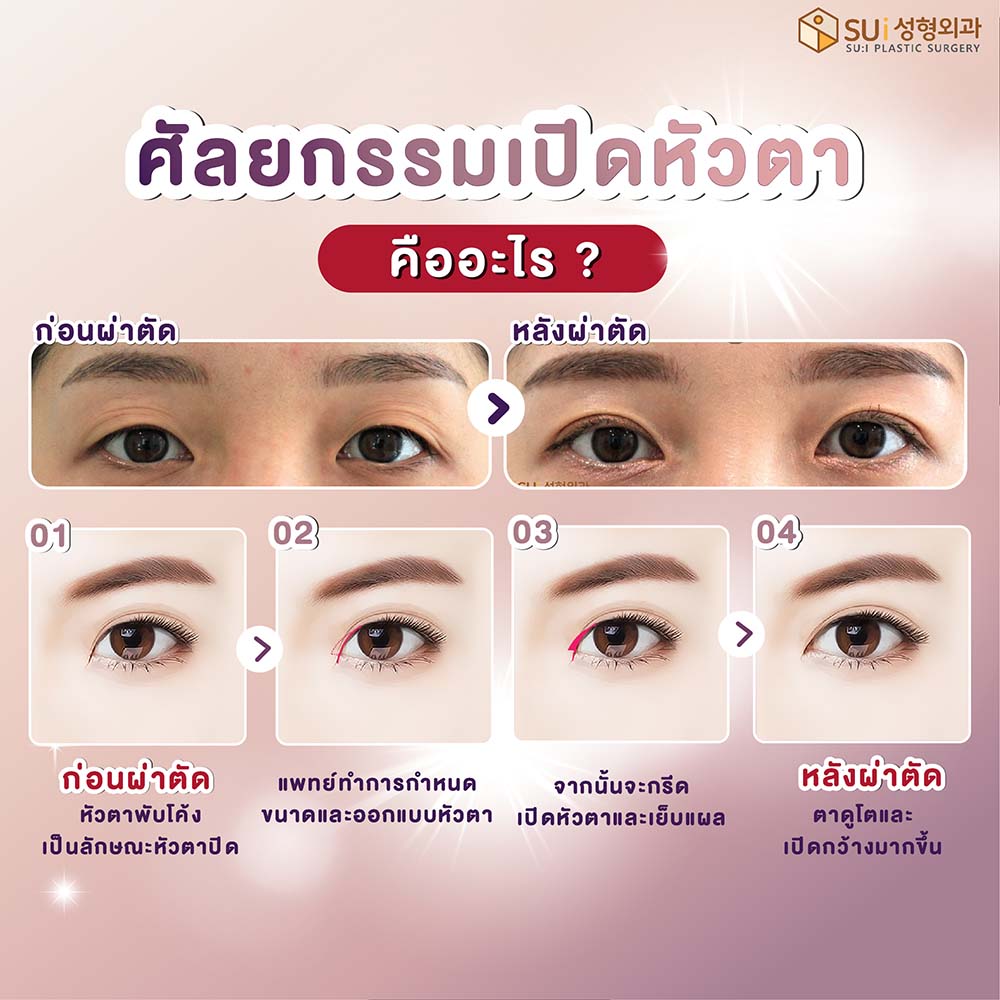 ศัลยกรรมเปิดหัวตา คืออะไร